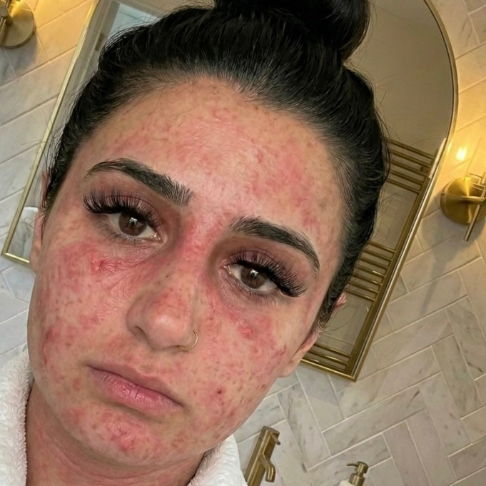 You've Tried Everything. Your Skin Still Won't Cooperate.
