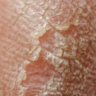 DRY / CRACKED SKIN