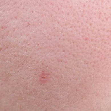 SENSITIVE SKIN