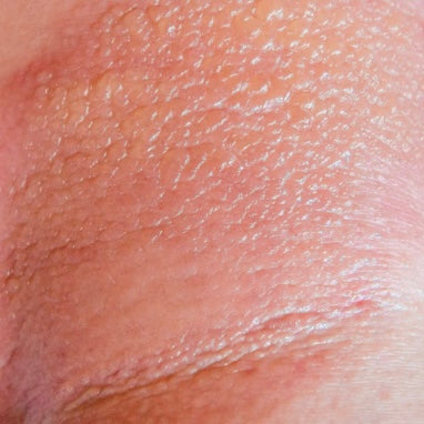 ECZEMA-PRONE SKIN