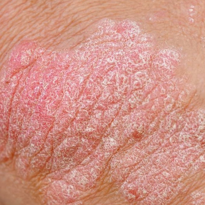 PSORIASIS-PRONE SKIN