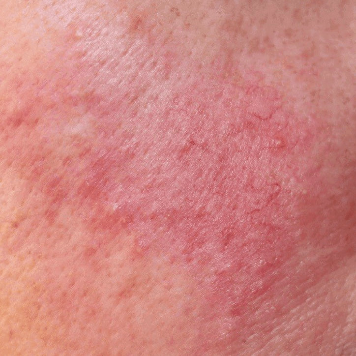REDNESS / ROSACEA