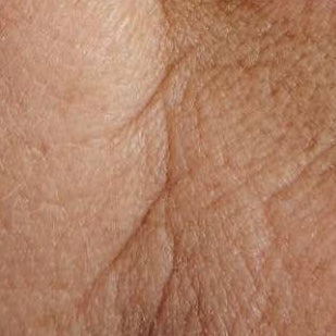 AGING SKIN