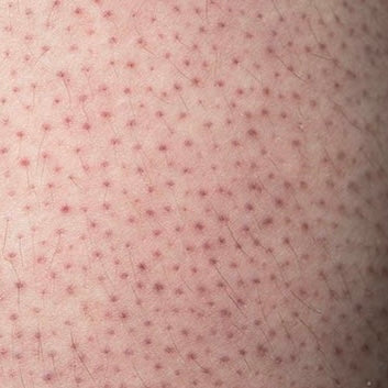 KERATOSIS PILARIS