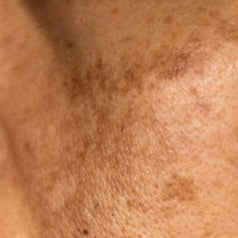 HYPER-PIGMENTATION
