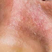 ITCHY, TIGHT SKIN
