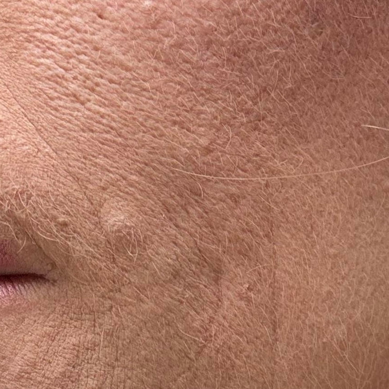 UNEVEN SKIN TEXTURE