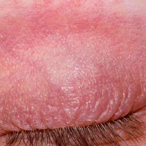 DERMATITIS