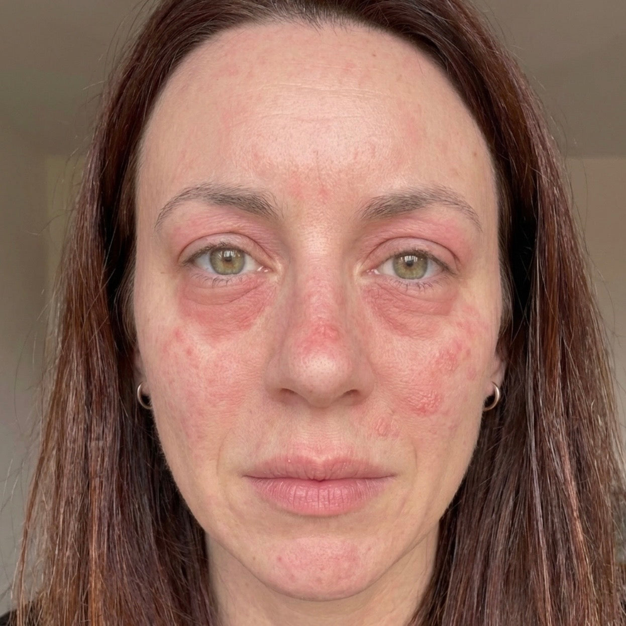 Face eczema