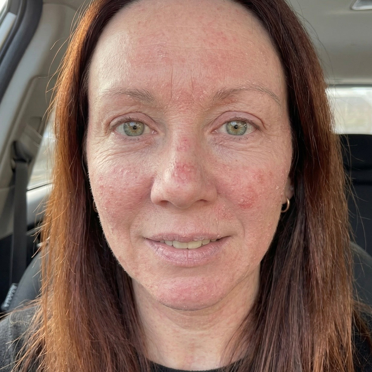 Eczema-Prone Skin Is Deficient In The Exact Lipids It Needs To Hold Moisture